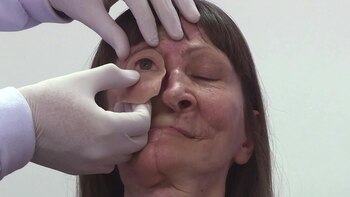 Prótesis de bajo costo para