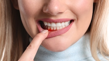 Mujer con gingivitis (Shutterstock)