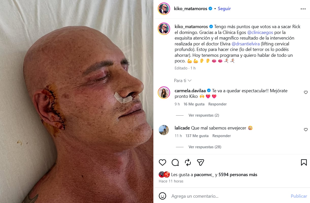 Las sobrecogedoras imágenes de Kiko Matamoros tras una nueva operación estética (Instagram)