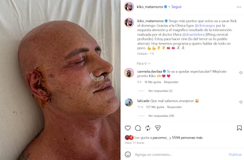 Las sobrecogedoras imágenes de Kiko Matamoros tras una nueva operación estética (Instagram)