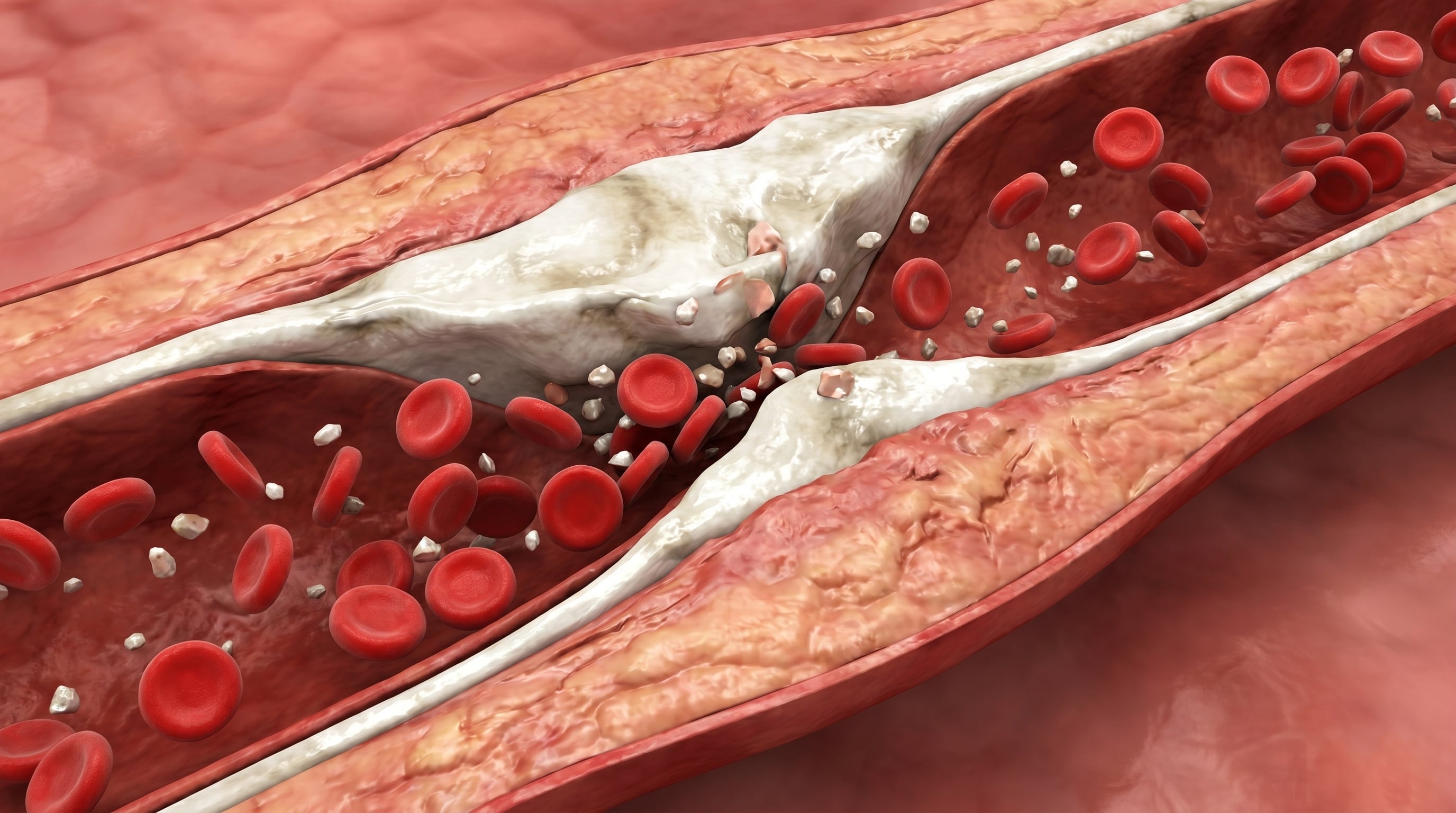 Más del 60% de la población adulta en países desarrollados muestra calcificación arterial a partir de los 50 años, según la Universidad de Maastricht (Imagen Ilustrativa Infobae)