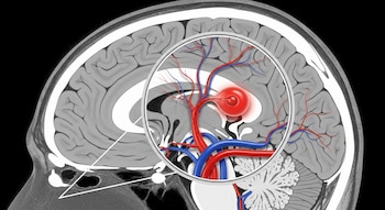 Vista sagital de una tomografía cerebral en escala de grises con un círculo de zoom que revela una aneurisma cerebral roja y vasos sanguíneos.