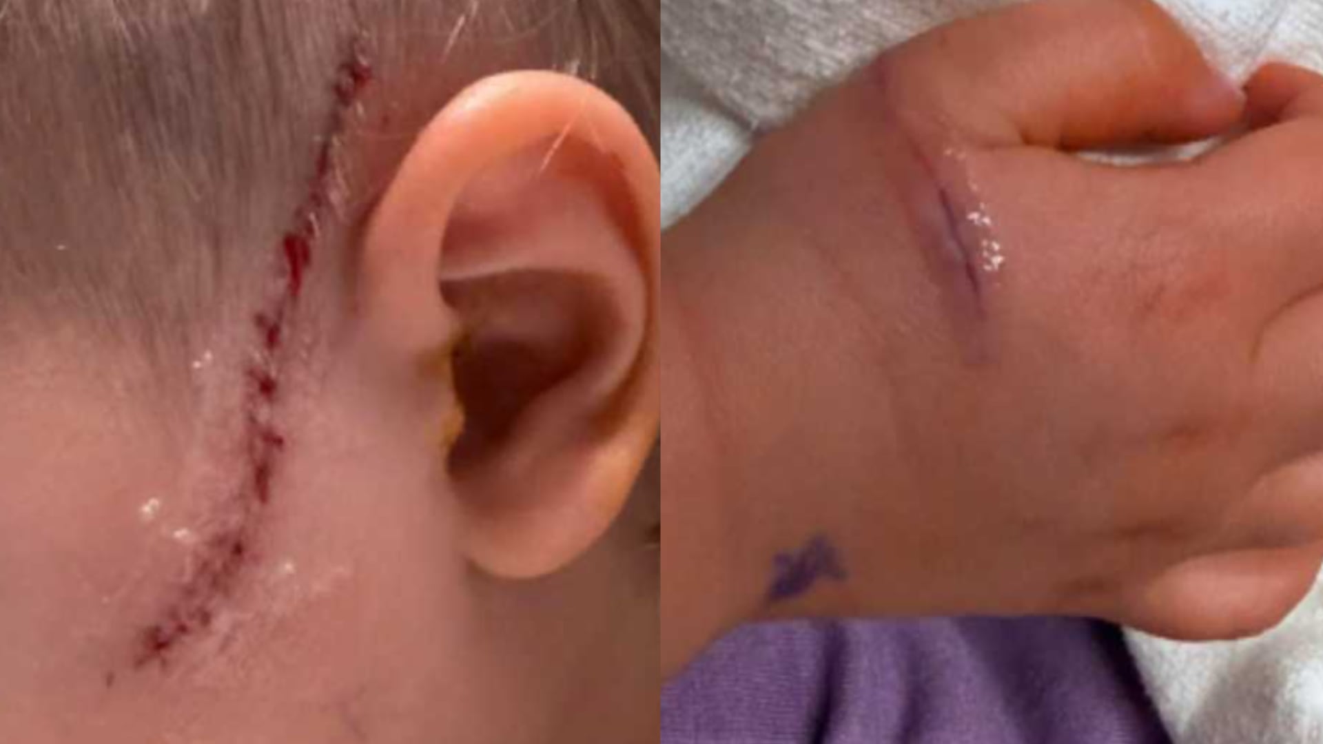 El menor sufrió cortes en el rostro y la mano, lesiones por las que debió recibir atención quirúrgica especializada en un hospital pediátrico (Familia Hillman)