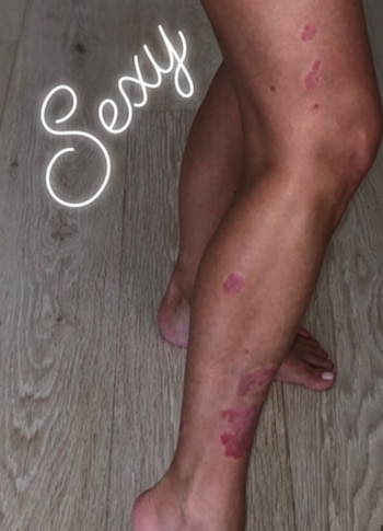 Ha probado diversos tratamientos, incluyendo