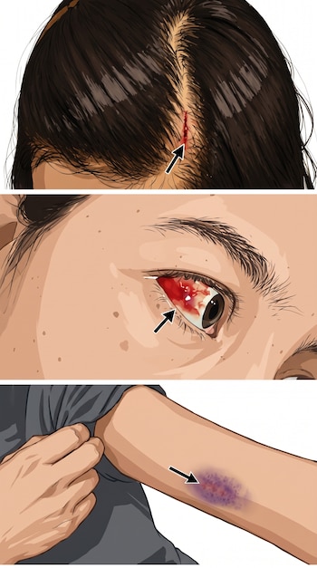 Tres paneles muestran una herida sangrante en el cuero cabelludo, un ojo con hemorragia subconjuntival y un brazo con hematoma violáceo de una mujer.