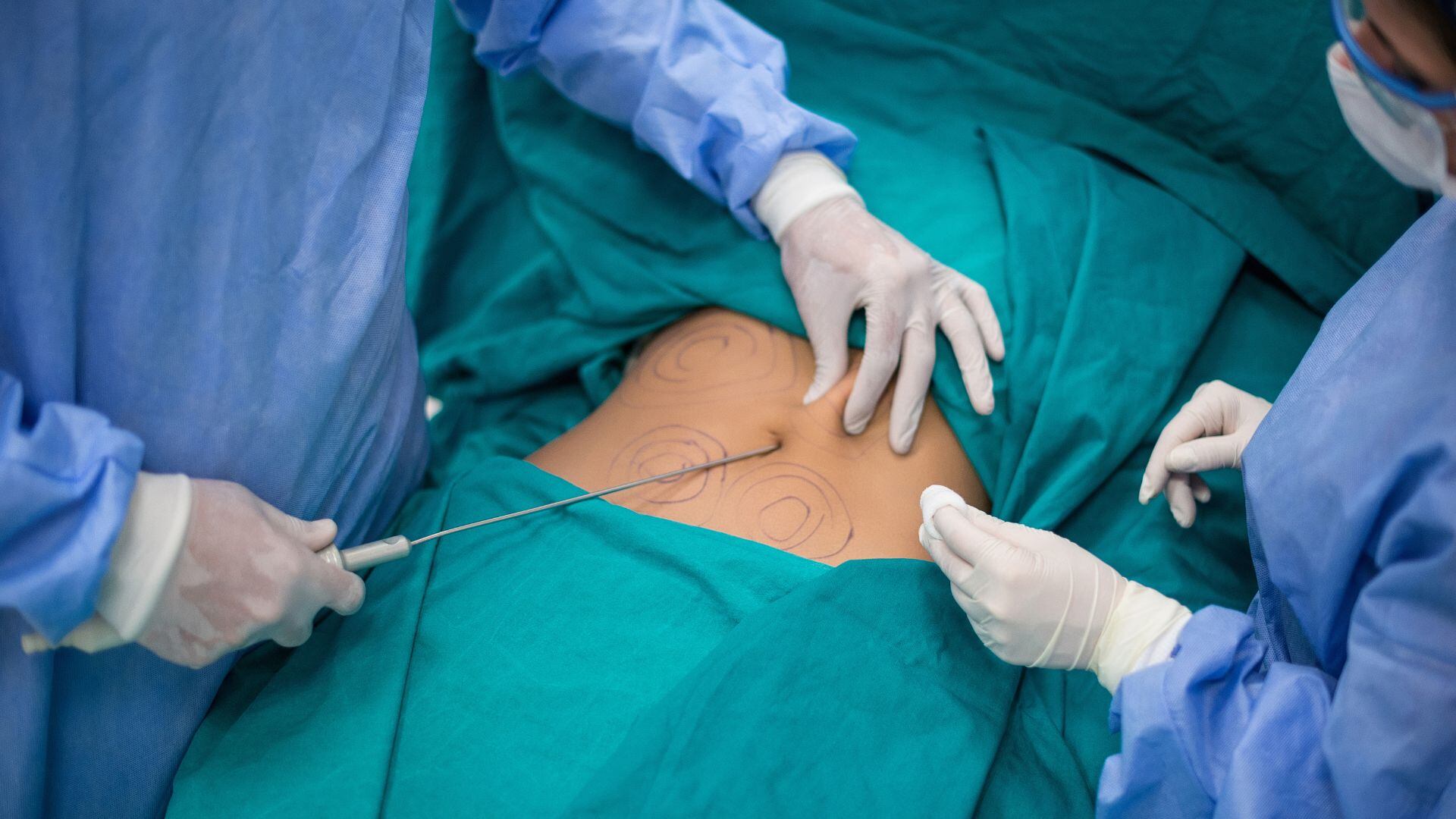 Una persona se realiza una liposucción. (Canva)