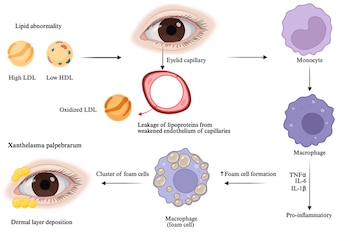 Fisiopatología del xantelasma palpebral (Atherosclerosis)