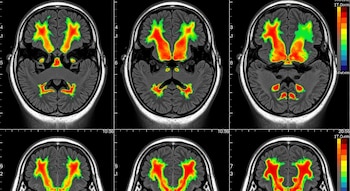 La Universidad Rockefeller identificó una