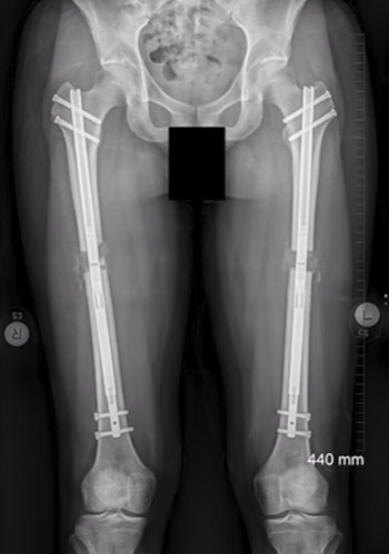 Radiografía en blanco y negro de la pelvis y las piernas con clavos metálicos y tornillos insertados a lo largo de ambos fémures
