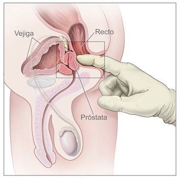Ilustración anatómica del sistema urogenital masculino, que muestra la vejiga, el recto y la próstata. Una mano enguantada realiza un examen rectal