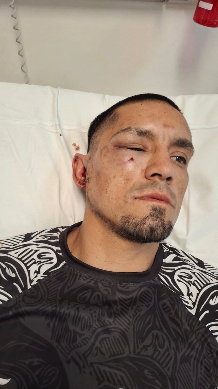 El hombre sufrió fractura del pómulo derecho y del maxilar derecho