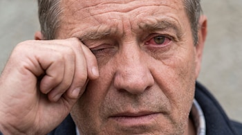 Primer plano del rostro de un hombre con el ojo derecho enrojecido, que se rasca con la mano izquierda, mostrando una expresión de incomodidad.