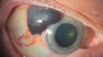 Primer plano de un ojo humano abierto con iris claro y pupila oscura, mostrando una lesión de color gris oscuro y forma irregular en la esclera blanca y rojiza