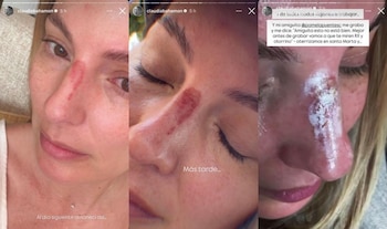 Bahmaón tuvo que buscar un médico para que la revisara de urgencia, al notar la gravedad de su herida en la nariz - crédito @claudiabahamon/Instagram