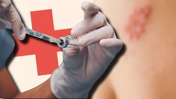 El herpes zóster es causado