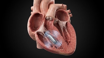 Un corazón humano seccionado muestra un marcapasos intracardíaco implantado en el ventrículo derecho con ondas luminosas azules.