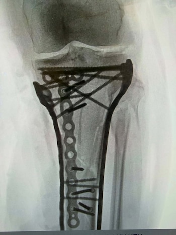 Lindsey Vonn mostró las radiografías