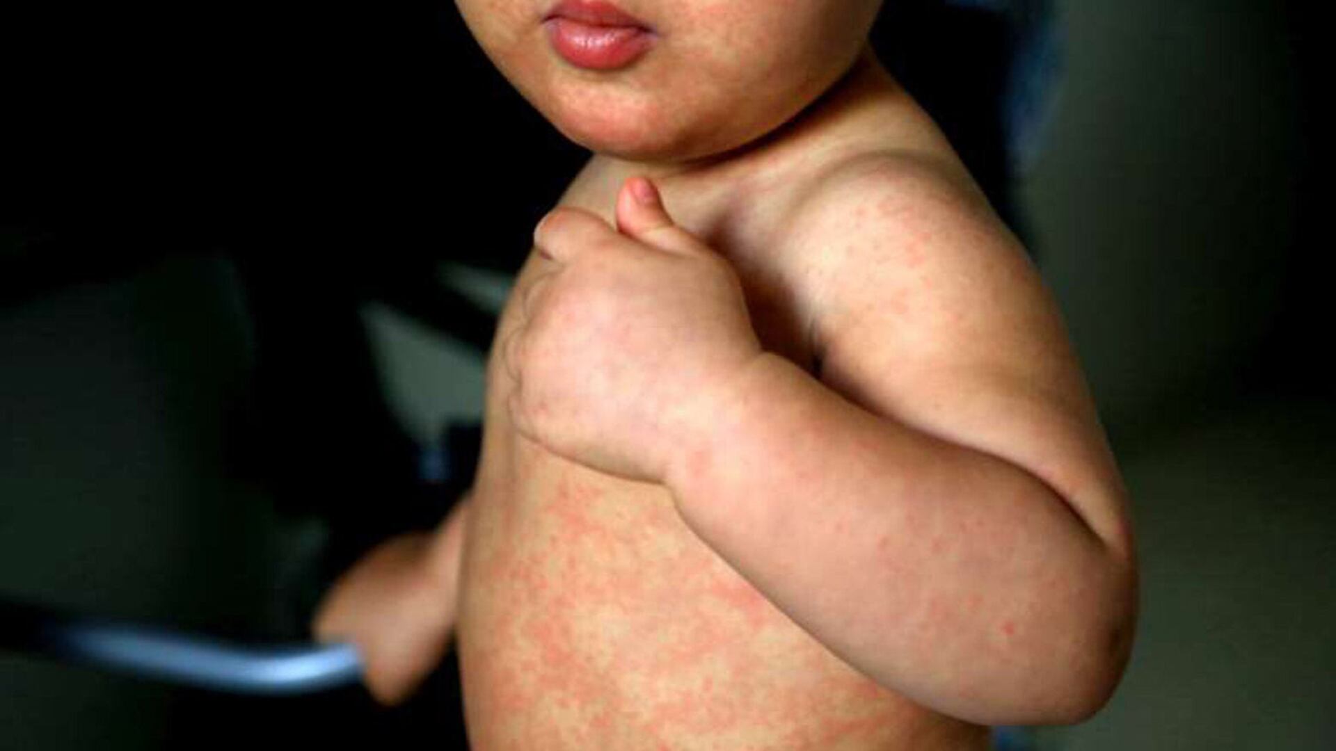 El sarampión es una enfermedad viral altamente contagiosa, especialmente peligrosa para niños menores de 5 años y desnutridos (www.paho.org)