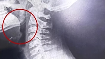 Comió una galletita y comenzó a escupir sangre: el sorprendente hallazgo que hicieron los médicos en su garganta