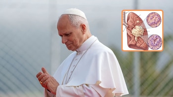 Qué es un adenocarcinoma pulmonar, enfermedad detectada al papa León XIV: experto analizó qué viene para el sumo pontífice