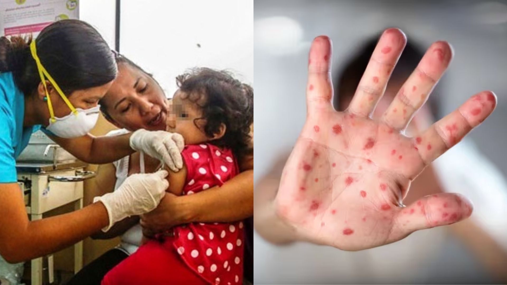 Sarampión es más contagioso que el COVID-19, coinciden expertos.