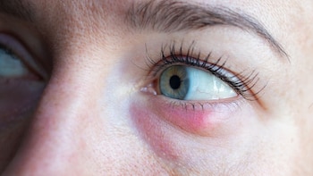 Una mujer tiene un orzuelo