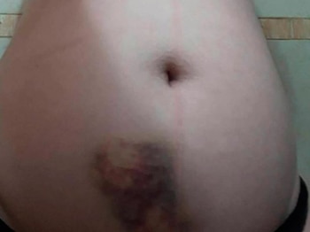 Las lesiones ocasionadas por Galante