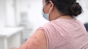 Honduras: salud confirma primer caso por transmisión local de sarampión