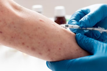 Brazo con sarpullido rojizo recibe inyección de jeringa sostenida por mano con guante médico azul