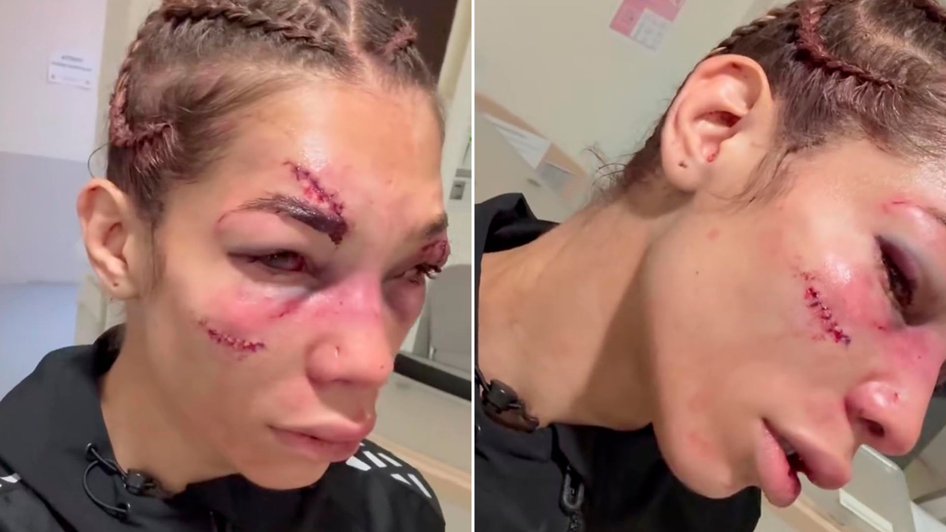 Así quedó el rostro de Sofía Montenegro tras caer en su estreno en UFC