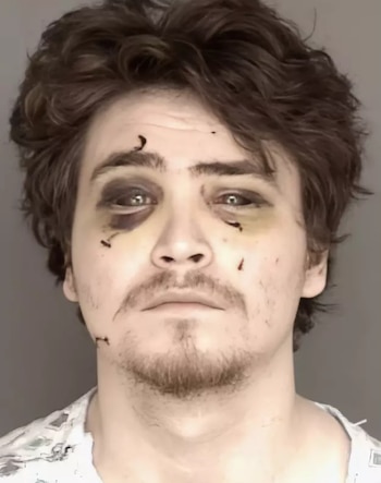 Retrato de un hombre de cabello castaño y barba. Presenta manchas oscuras bajo los ojos y pequeñas marcas rojas en la frente, mejillas y mentón