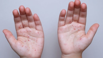 El brote de sarampión en Guatemala alcanza más de cuatro mil casos