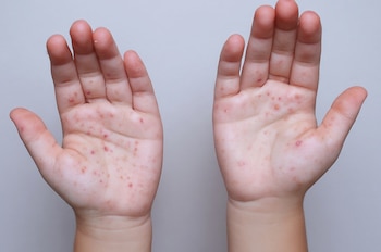 Panamá no registra casos autóctonos de sarampión desde 1995, año en que se confirmó el último contagio de origen local en el país. Cortesía Minsa