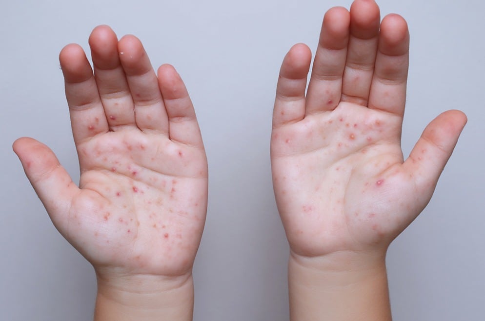 Panamá no registra casos autóctonos de sarampión desde 1995, año en que se confirmó el último contagio de origen local en el país. Cortesía Minsa