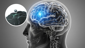 Implante cerebral y depresión: detalles sobre el primer ensayo en personas