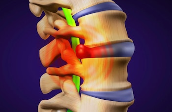 Las hernias suelen curarse con