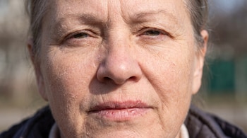 Rostro de mujer adulta mayor, cabello canoso, piel con descamación y arrugas, labio inferior con lesión.