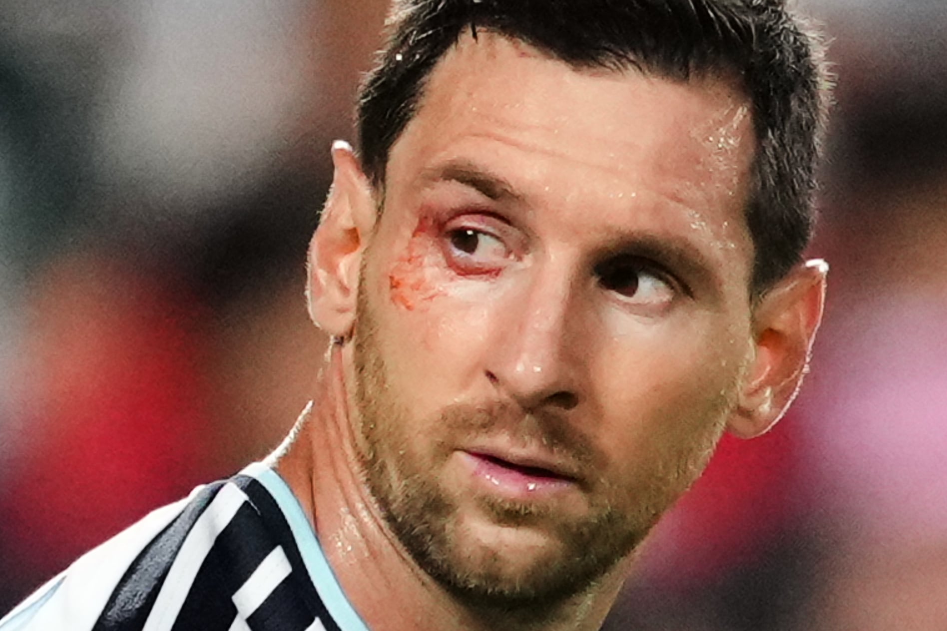 El corte en el ojo derecho de Lionel Messi durante el partido contra Suiza (AP Photo/Ed Zurga)