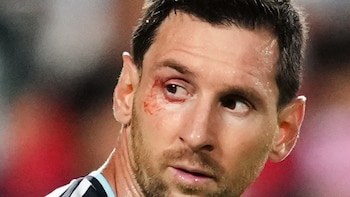 El corte en el ojo que sufrió Lionel Messi durante el duelo entre Argentina y Suiza del Mundial 2026