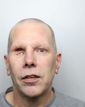 Rostro de hombre con pelo corto, camiseta gris, un ojo de iris claro abierto y el área del ojo izquierdo con cicatrices. Fondo blanco