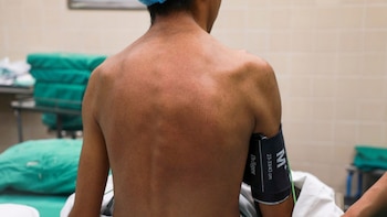 La precisión digital facilitó una operación segura, menos invasiva y con menor riesgo para la médula espinal - Créditos: Essalud.
