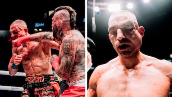 La impactante lesión que sufrió en el rostro un luchador durante una pelea de boxeo sin guantes