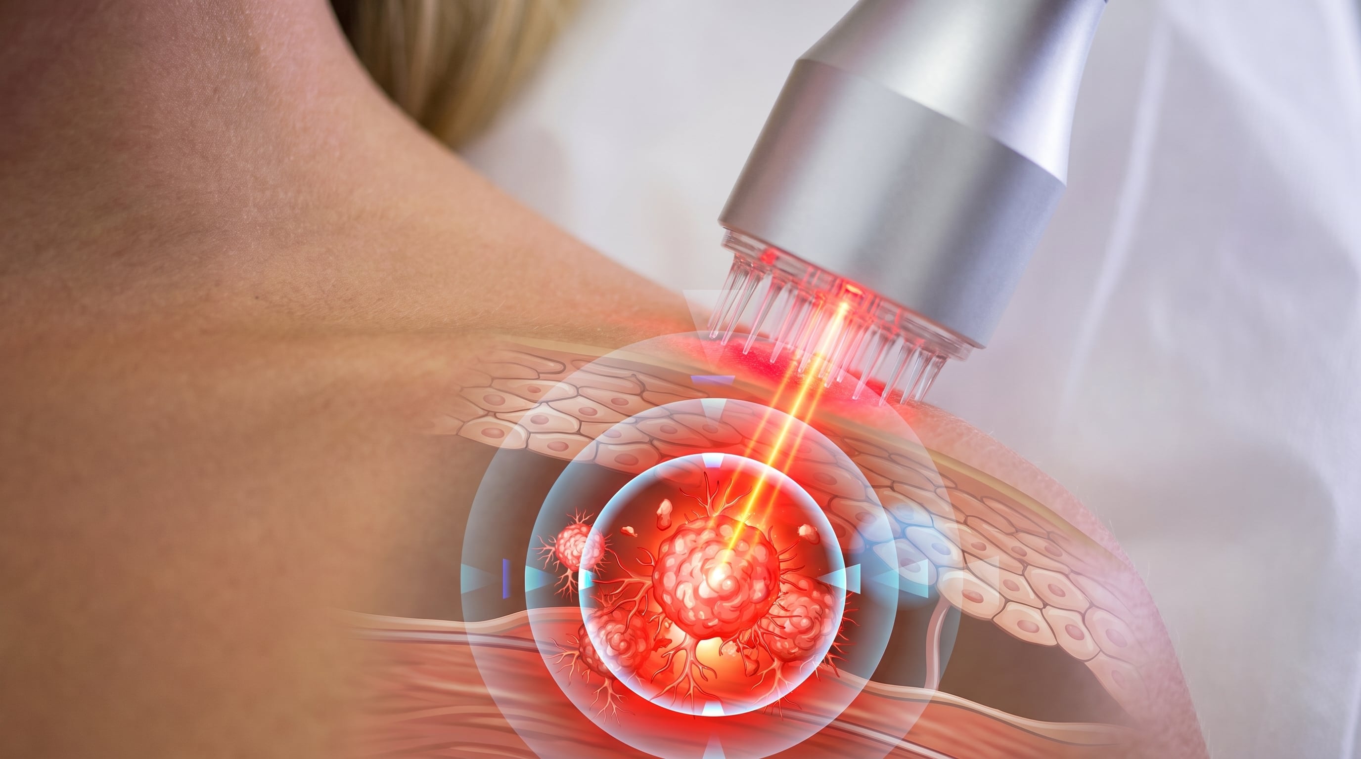 Científicos crean unas microagujas que ayudan a que la luz entre y ataque al cáncer de piel más difícil de tratar