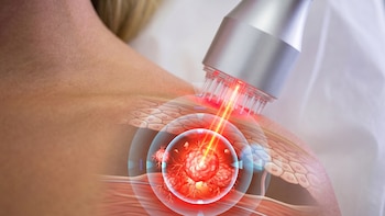 Científicos crean unas microagujas que ayudan a que la luz entre y ataque al cáncer de piel más difícil de tratar
