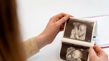 El caso de las dos gemelas que desarrollaron cáncer antes de nacer: el tumor se gestó en el útero y una hermana se lo pasó a la otra