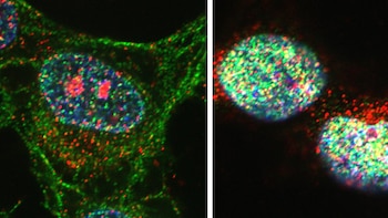 Identifican una causa genética de resistencia al tratamiento del cáncer de próstata