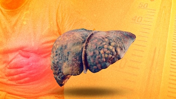 Hígado graso: así es como el calor agrava el daño hepático