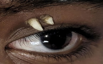 Primer caso de dientes que crecen en la órbita ocular