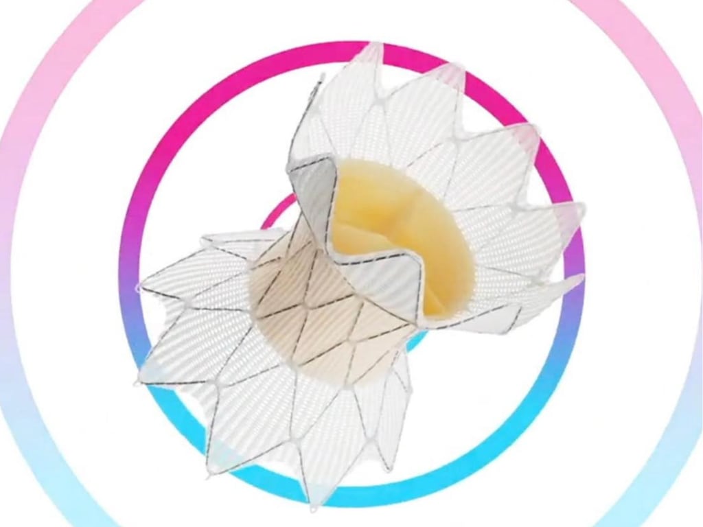 El diseño autoexpandible de la válvula pulmonar Harmony, con forma de reloj de arena, amplía las posibilidades de tratamiento en anatomías complejas (Hospital Austral)