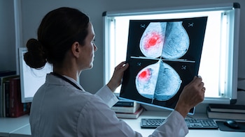 Cómo los ensayos clínicos pueden ampliar las opciones de tratamiento contra el cáncer en América Latina